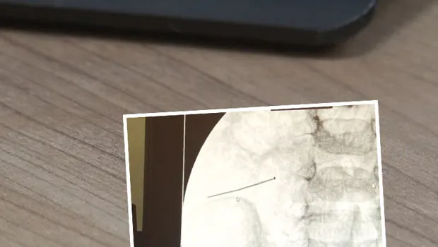 2 Yaşındaki Çocuğun Bağırsğından İğne Çıktı! Şoke Eden Olay