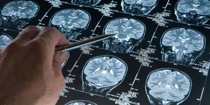 Alzheimer'a Son Mu? Yeni Kan Testi Umut Saçıyor!